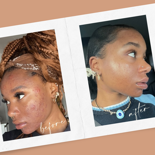 Your Skin Barrier Is Screaming Here’s How to Heal It for Good