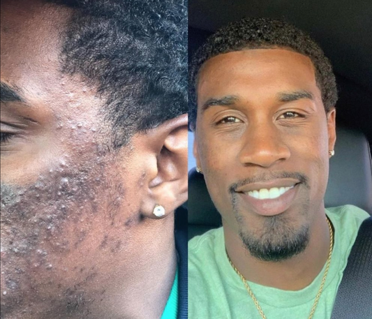 From Overwhelmed to Radiant: A Simple Path to Healing Your Skin